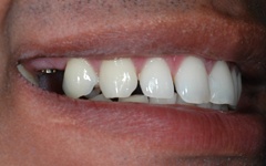 Closeup of smile before dental implant tooth replacement