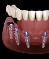 Digital illustration of implant dentures