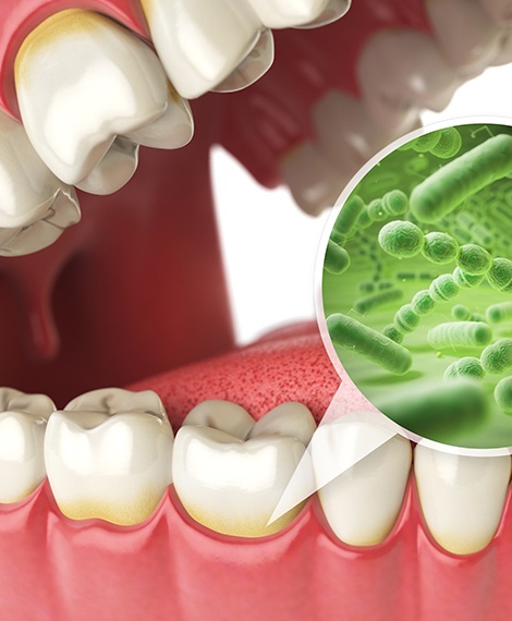 A 3D illustration highlighting bacteria around the gumline