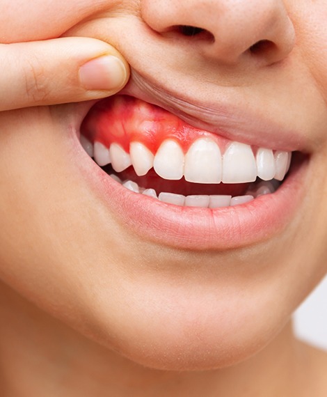 A woman revealing her red and inflamed gums