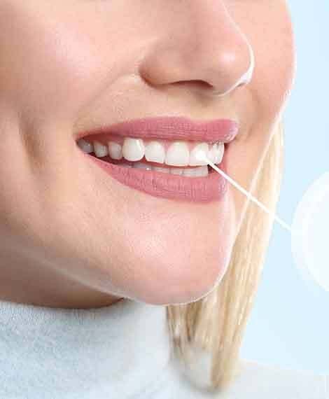 woman smiling with dental implant in mouth 