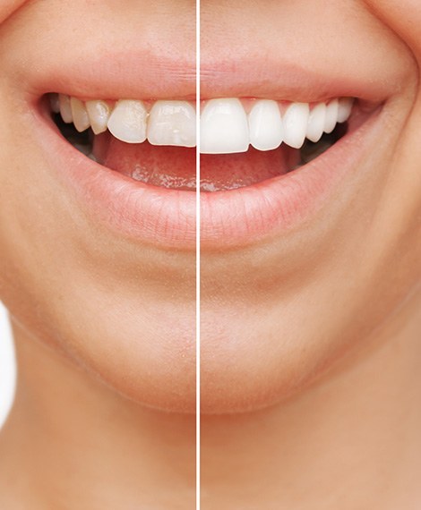 A before and after of getting veneers